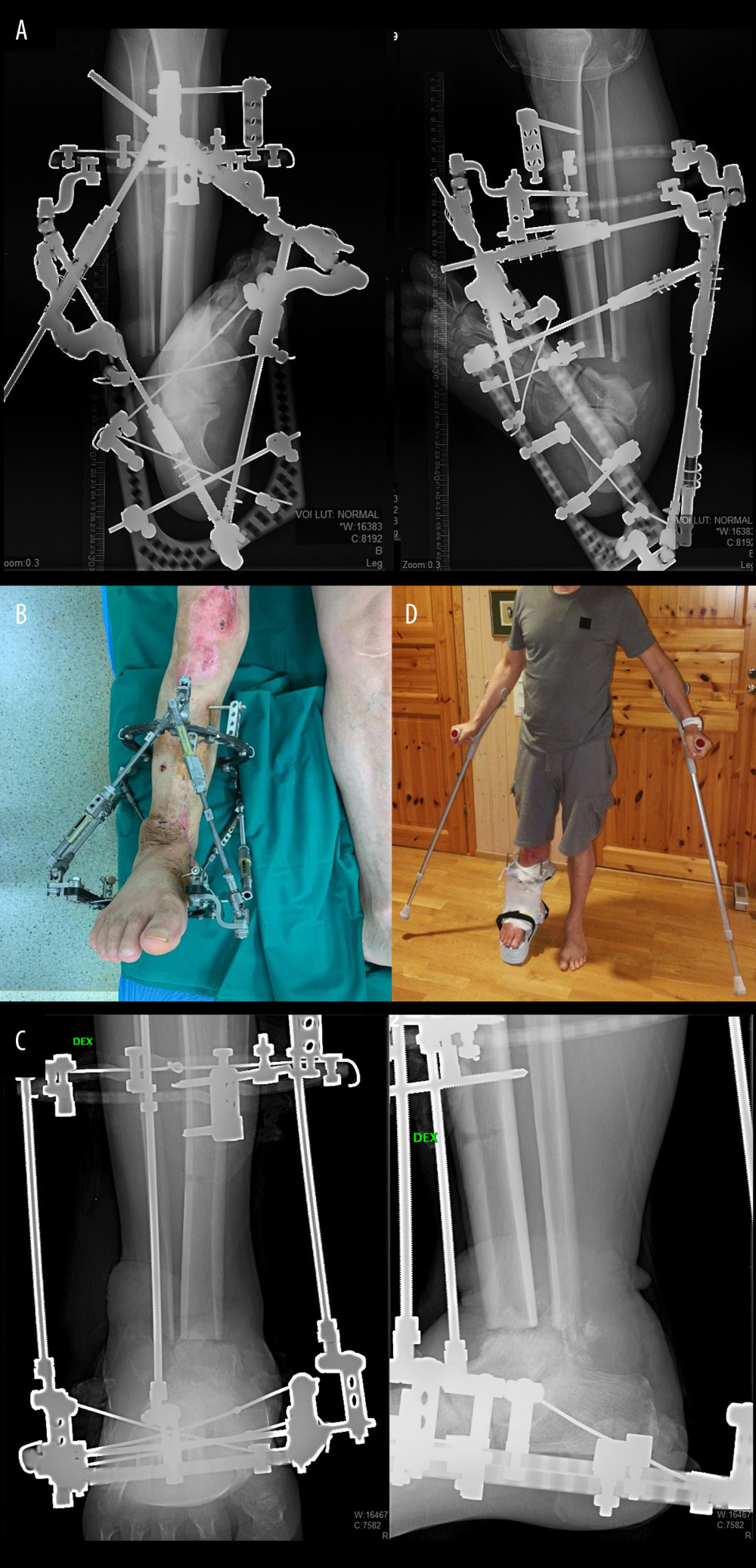 (A) X-rays (anteroposterior and lateral) after orthopedic hexapod mounting, to perform the deformity correction calculations. (B) Clinical photograph showing the end of artificial deformity correction using orthopedic hexapod. (C) X-ray (anteroposterior and lateral) presenting talocrural arthrodesis as fixation method using the Ilizarov frame. (D) Clinical photograph showing the patient before discharging from the hospital using crutches with partial weight-bearing.
