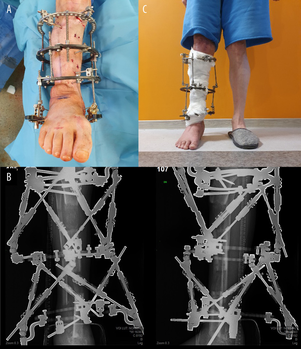(A) Clinical photograph showing the limb lengthening by the double-level osteotomy using Ilizarov frame. (B) X-rays (anteroposterior and lateral) presenting 2 hexapods applied for the secondary deformity correction. (C) Clinical photograph showing the leg length and anatomical alignment were fully restored.