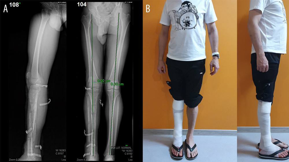 (A) X-rays (lateral and anteroposterior) showing anatomical axis after length restoration and good ossification of the regenerate. (B) Clinical photograph presenting final results with the patient fully weight-bearing with no concerns.