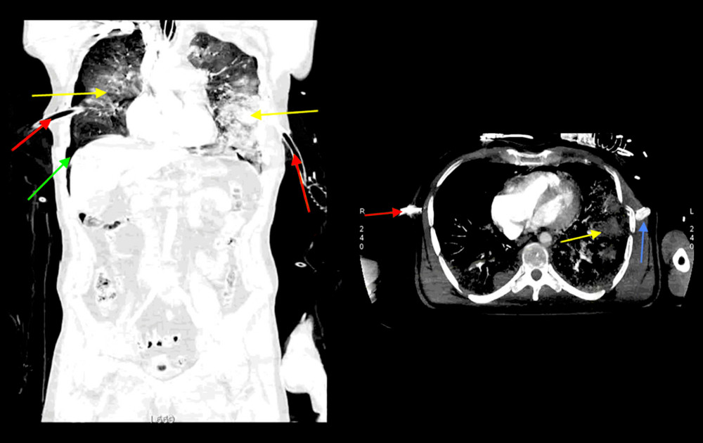 CT scans of first examination: yellow arrows – well-defined consolidation might correspond to the contusion of the lungs; red arrows – drains; green arrow – pneumothorax; blue arrow - broken ribs.