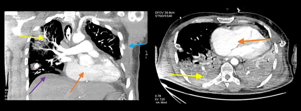 Control CT scans (on day 3): yellow arrows – consolidations might correspond to a contusion of the lungs; orange arrows – heart enlarged in the transverse dimension; blue arrow – broken ribs; purple arrow – fluid in the abdominal cavity.