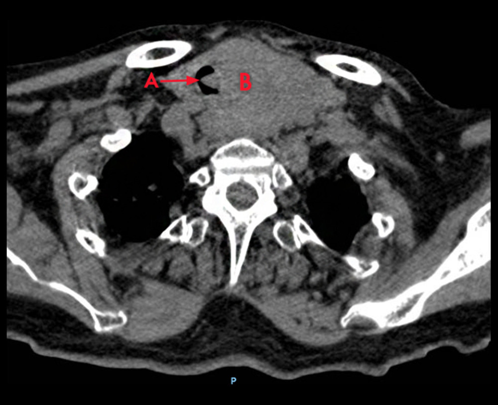 Axial image of a neck CT scan without contrast showing the left neck lesion causing mass effect and tracheal displacement to the right as well as intraluminal extension. A) Intra-tracheal mass. B) Extra-tracheal mass.