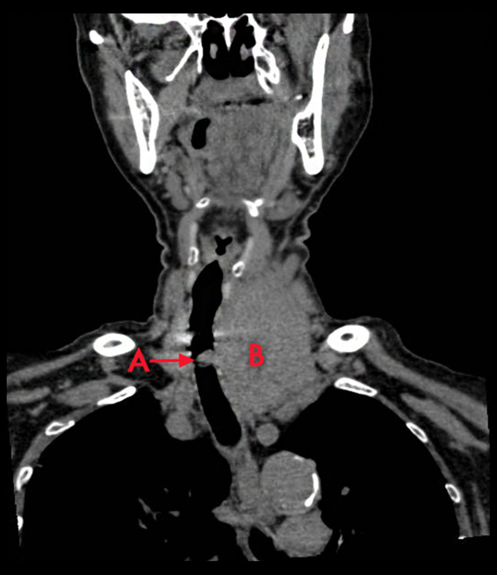 Coronal image of a neck CT scan without contrast showing the left neck lesion causing mass effect and tracheal displacement to the right as well as intraluminal extension. A) Intra-tracheal mass. B) Extra-tracheal mass.