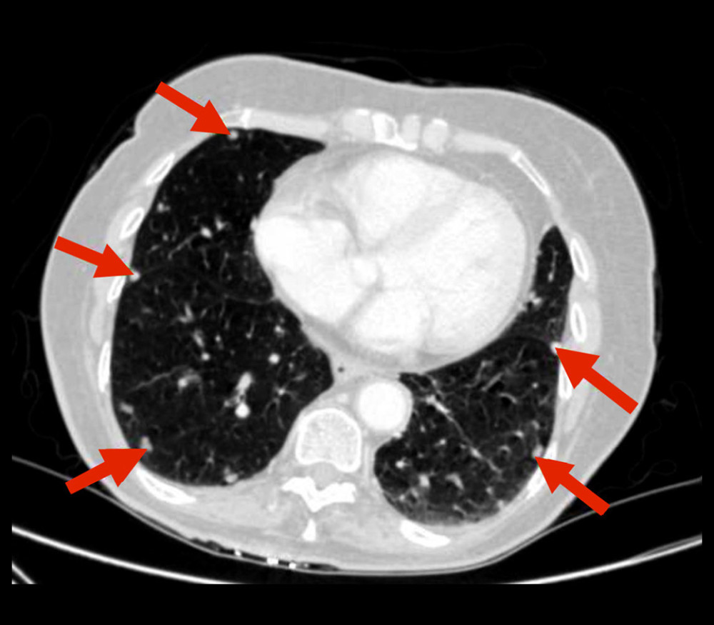Axial image, lung view, of a chest CT scan with i.v. contrast showing multiple pulmonary nodules associated to metastatic disease.