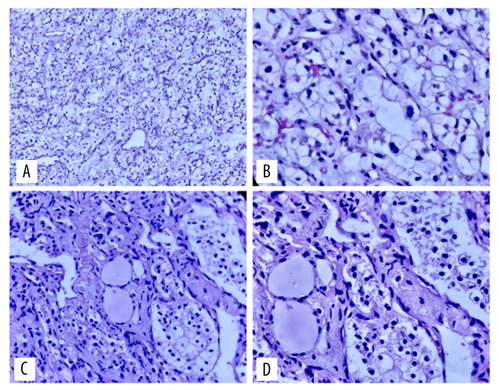 (A) Note the nearly complete replacement of the thyroid by tumor cells with clear cytoplasm, distinct cytoplasmic membranes, and delicate network of thin vessels around tumor nests, H&E, 20×. (B) Pleomorphic and hyperchromatic cells, some with prominent eosinophilic nucleoli, H&E, 40×. (C) Residual thyroid follicles (at center) surrounded by nests of clear cell carcinoma tumor, H&E, 20×, and (D) At higher magnification, H&E, 60×.