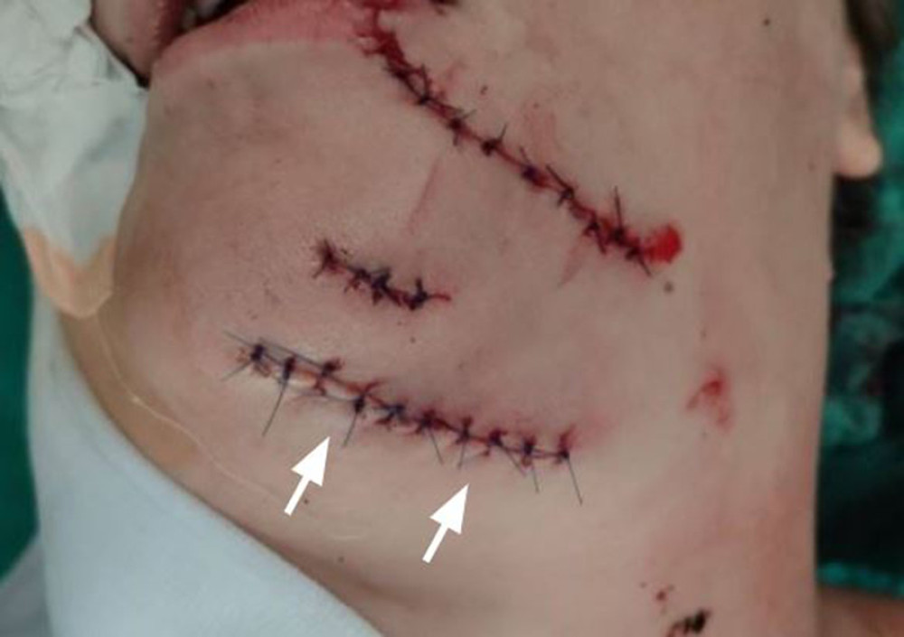 Photograph of the facial and upper cervical stab wounds that the patient presented on admission. The white arrows show the wound injury that reached the left submandibular gland.