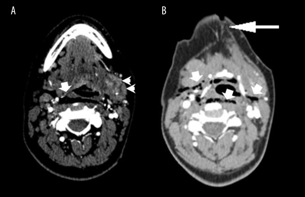 CT scan of the neck and axial images at the level of the submandibular space. The left submandibular gland is enlarged and demonstrates a heterogeneous appearance with an anterior hypodense area (arrowheads, Figure 1) in keeping with laceration of the gland. The hyperdense foci represent focal intraglandular bleeding. Air bubbles are observed in both the submandibular and retropharyngeal spaces (arrows, A, B). There is a lineal disruption of the skin and the underlying subcutaneous fat (arrow, B) in the submandibular region, reaching the left submandibular space and revealing the wound trajectory.