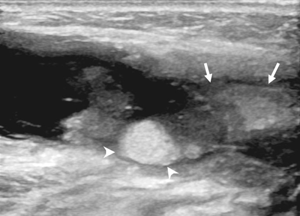 Longitudinal neck US image. There is an anechoic collection at the submandibular region with hyperechoic clots (arrowheads). This collection disrupts the submandibular gland (arrows).
