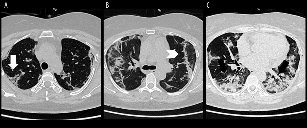 Axial sections of the first CT scan dated October 24, 2020 at the level of the aortic arch (A), carinal bifurcation (B), and bronchial bifurcation to middle and right lower lobe branches (C) showing multiple ground-glass opacities with confluences and consolidation (black arrow) and with unsharp demarcations. The focal discrete ground-glass opacities with intralobular septal thickening (white arrow) mostly occupy the periphery of the upper lobes, while the consolidations are noted predominantly in the bilateral lower lobes, with interspersed tubular bronchiectasis. Sub-pleural bands (arrow head) are also seen bilaterally.