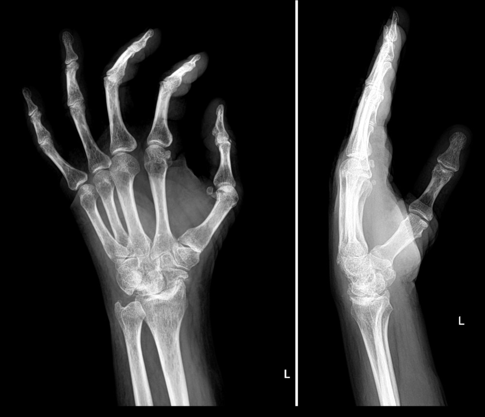Anteroposterior (AP) and lateral projections radiographs of the left hand, showing narrowing of the radio-carpal space associated with sclerosis and calcification of the distal radio-ulnar joint.