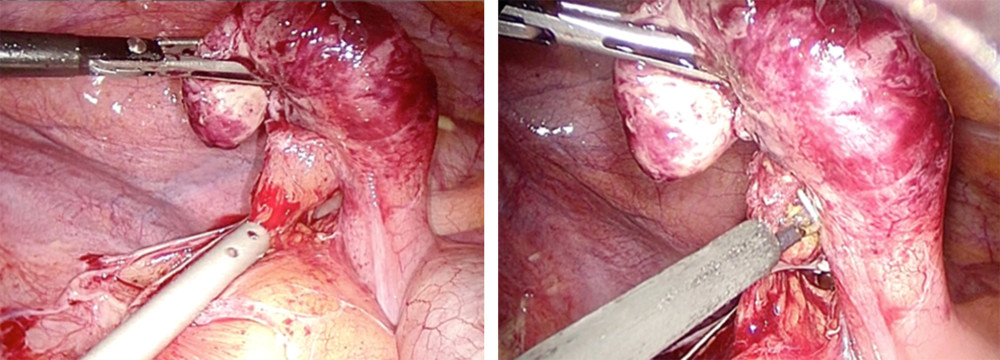 The intraoperative findings showing an inflamed and enlarged vermiform appendix with early mass formation without gross evidence of appendiceal diverticulum.