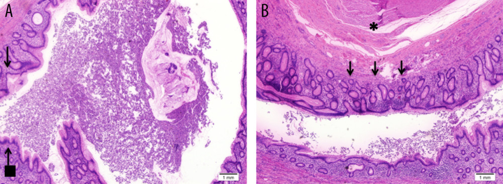 Photomicrographs of the histopathology of the resected appendix using hematoxylin and eosin (H&E) and with 20× magnification. (A) A section through the appendix tip showing a thin-walled diverticulum containing acute inflammatory exudate (arrow). (B) A section through the appendix tip showing continuity of the diverticulum with marked inflammation (arrows) along with hypertrophy of the muscular wall (asterisk).