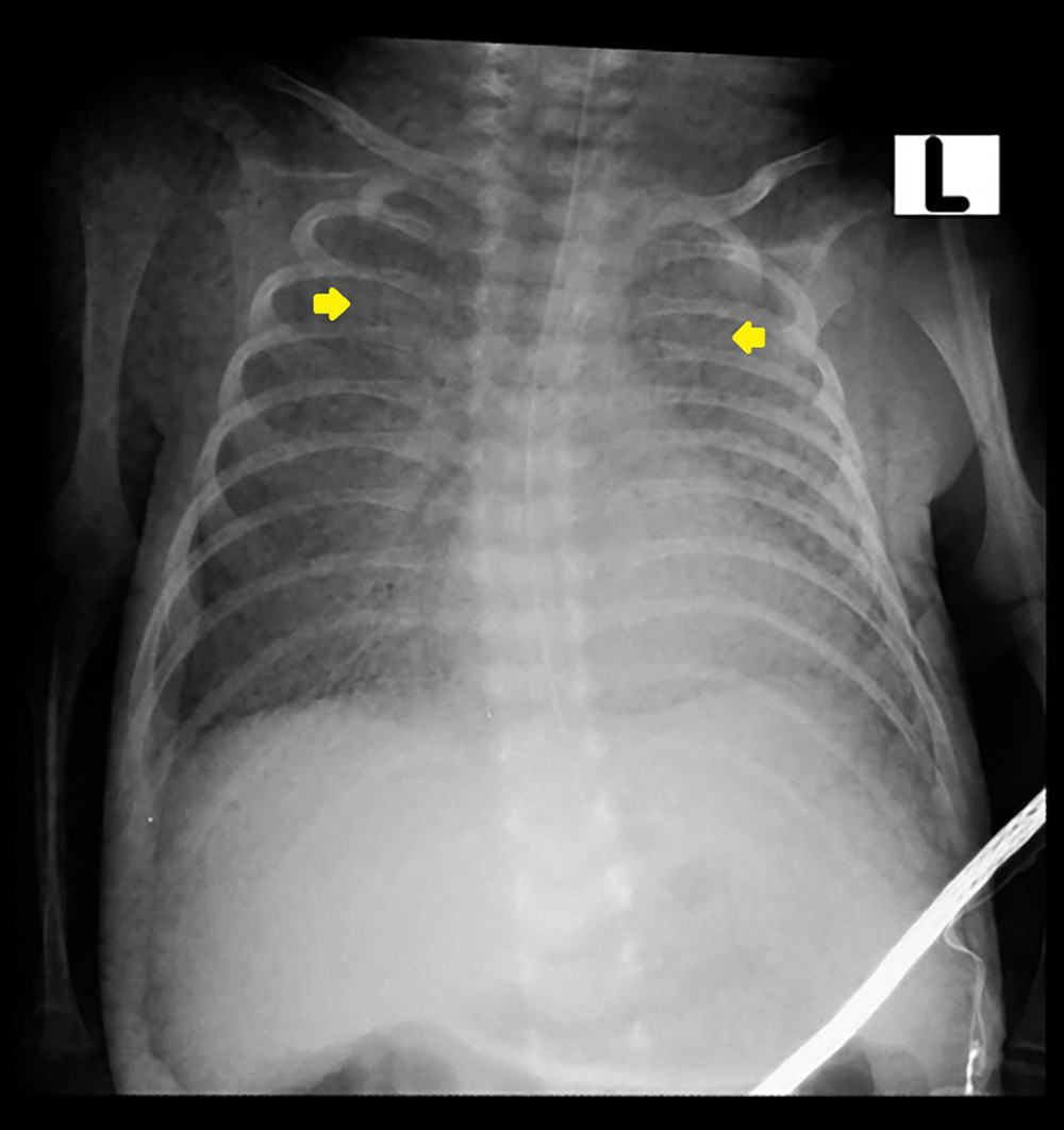 Patient AP chest X-ray showing diffuse bilateral infiltrate (indicated by the 2 yellow arrows).