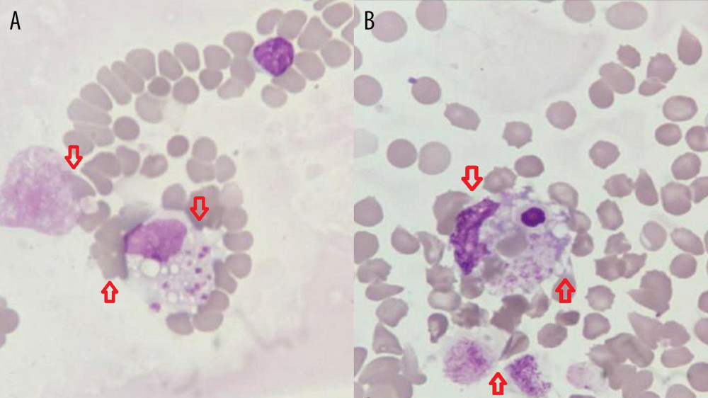(A, B) Bone marrow aspirate that showed hemophagocytic activity of both red blood cells and platelets (indicated by the red arrows).