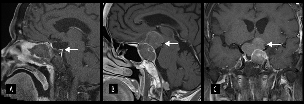MRI brain in 2019 following transsphenoidal resection of the pituitary tumor. (A) Sagittal T1-weighted post-contrast image shows reduction in size of the sellar mass (arrow). (B) Sagittal T1-weighted post-contrast image shows subsequent recurrent pituitary mass (arrow). (C) Coronal T1-weighted post-contrast image shows superior and lateral extension of the pituitary mass indenting on the hypothalamus (arrow).