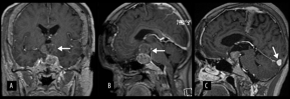 MRI brain following bifrontal craniotomy and partial resection of the recurrent pituitary tumor in 2019. (A) Coronal and (B) sagittal T1-weighted post-contrast image showing the remnant pituitary tumor after surgery (arrows). (C) Sagittal T1-weighted post-contrast image following stereotactic radiation therapy (SRT) with interval reduction in size of the remnant recurrent pituitary tumor however, a new left posterior fossa dural-based tumor was detected (arrow).
