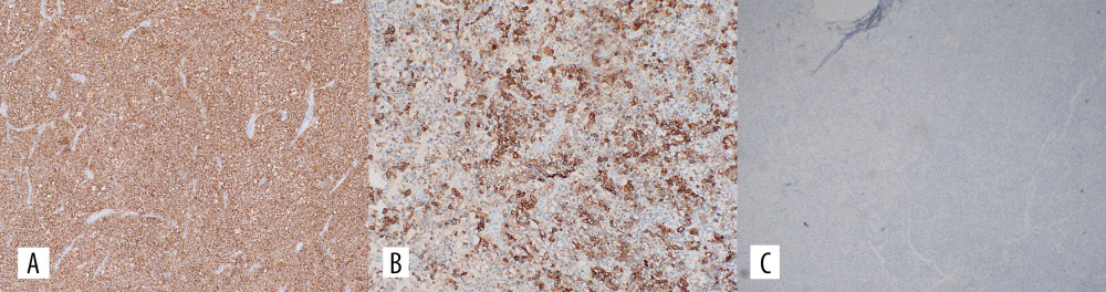 Immunohistochemical staining of the resected left frontotemporal tumor of the woman with pituitary carcinoma in 2021. The tumor shows high positivity for (A) synaptophysin and (B) ACTH. This confirms the pituitary origin of the tumor. (C) Epithelial membrane antigen (EMA) is negative, thus excluding the possibility of meningioma.