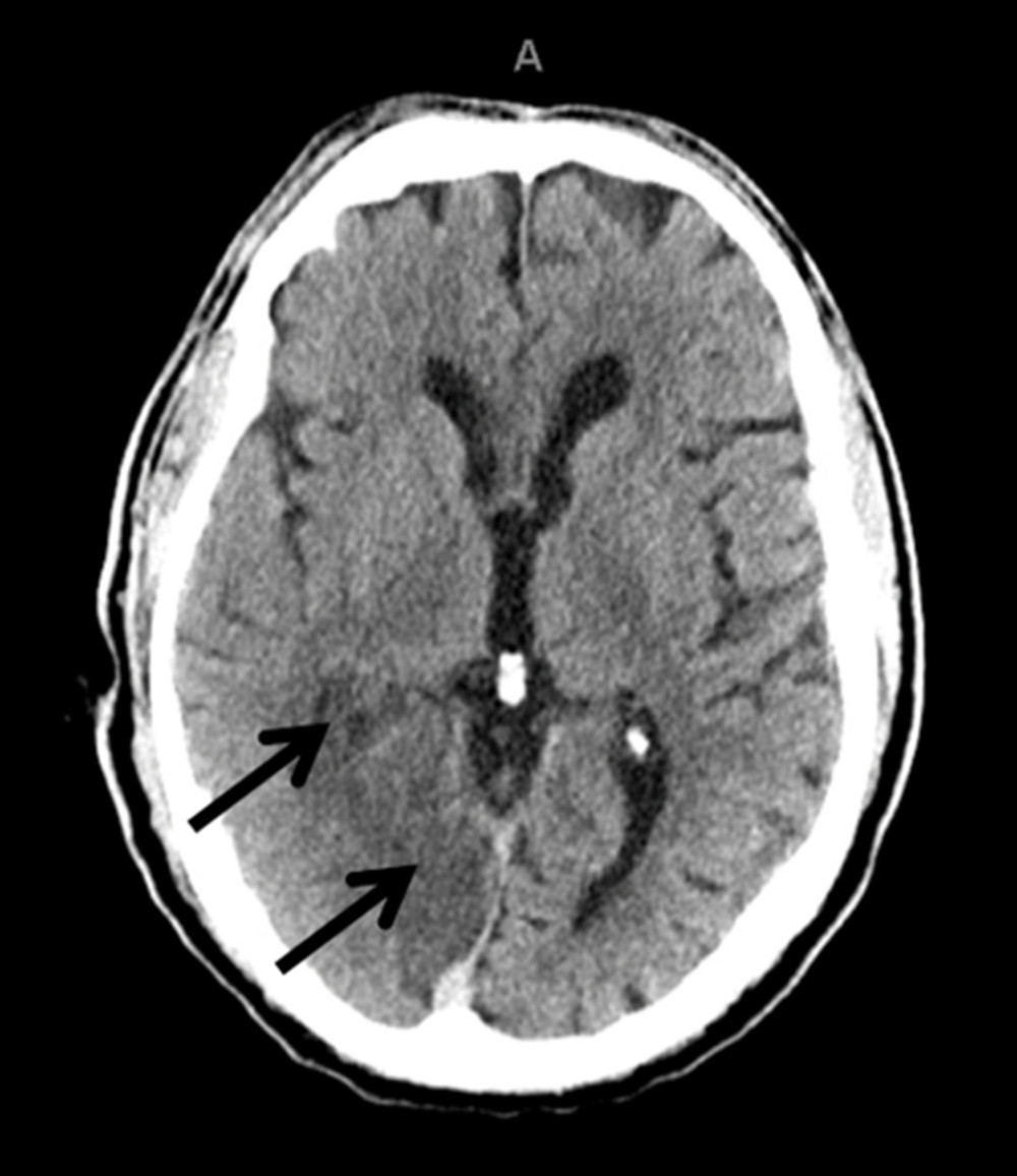 CT head without contrast with black arrows showing decreased density representing acute right posterior cerebral artery distribution infarct.