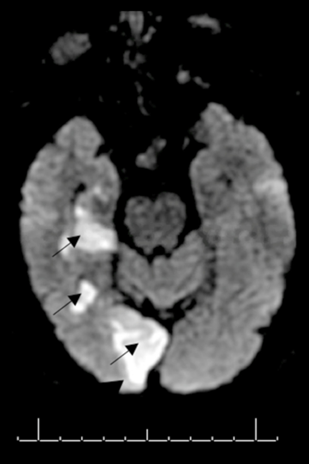 Axial diffusion-weighted MRI brain without contrast, with black arrows demonstrating acute-to-subacute right posterior cerebellar artery (PCA) territory infarction involving the posterior right temporal and right occipital lobes.