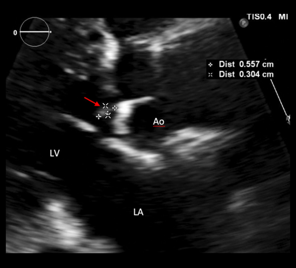 Transthoracic echocardiography showing 6×3 mm echo density seen on the ventricle surface of the left coronary cusp. Ao – aorta; LA – left atrium; LV – left ventricle.