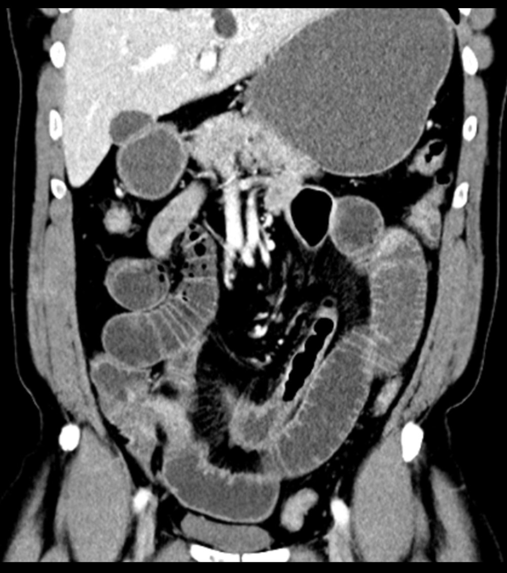 Initial computed tomography scan showing small bowel obstruction in the right lower quadrant.