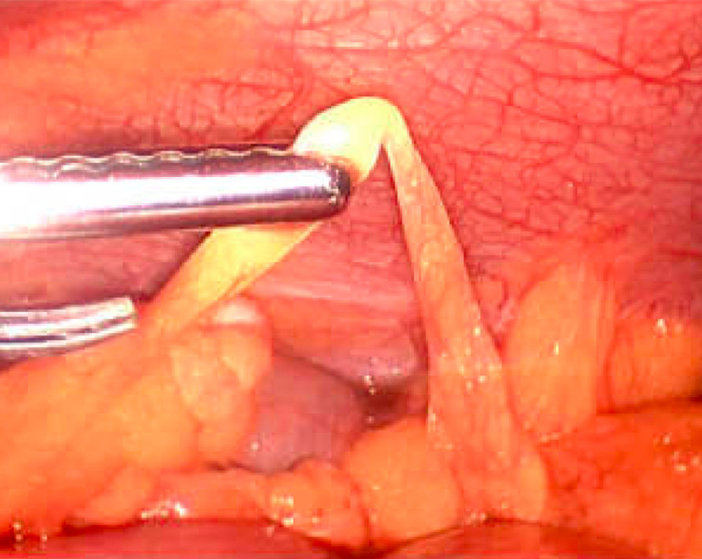Diagnostic laparoscopy demonstrating band in the right lower quadrant across the terminal ileum.