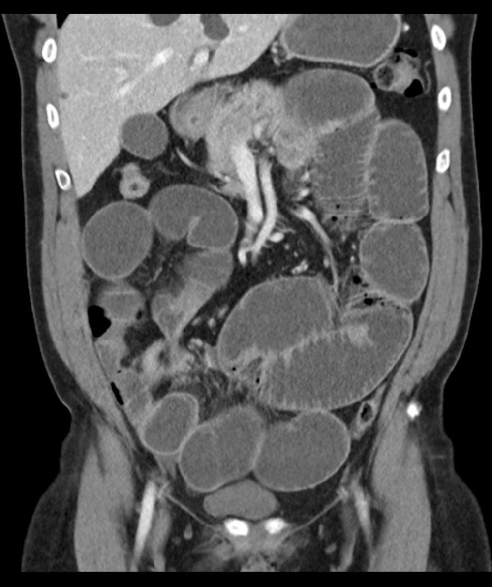 Computed tomography demonstrating progression and worsening of high-grade small bowel obstruction with transition in the right lower quadrant.