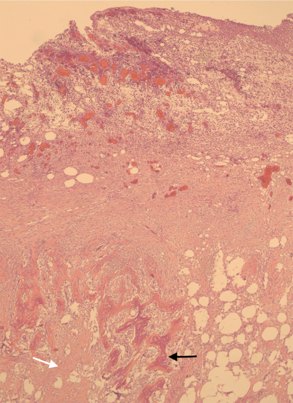 Histological analysis of surgical specimen. Wide image demonstrating mesenteric fibrosis (white arrow) and adhesion with idiopathic ossification (black arrow).