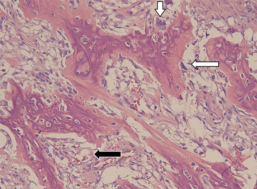 Histological analysis of surgical specimen. Increased magnification presenting heterogeneous background of stromal cells with osteoblast (black arrow) and osteoclasts (white arrow).