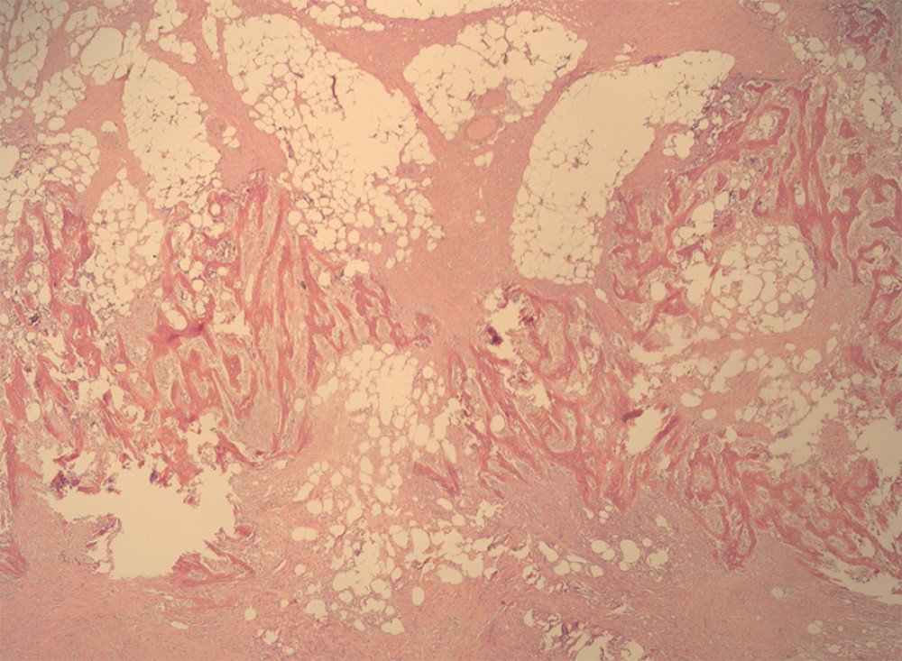 Histological analysis of surgical specimen. Ossification organizing in a band-like layer.