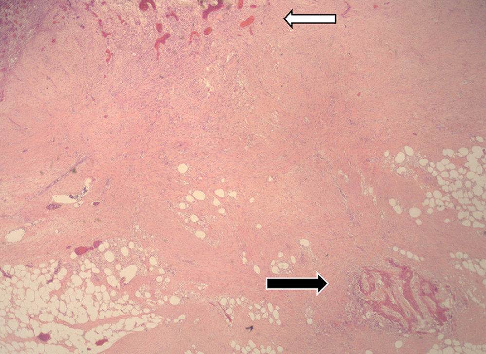Histological analysis of surgical specimen. Isolated areas of ossification as depicted (black arrow) in background of fibrous adhesion (white arrow).