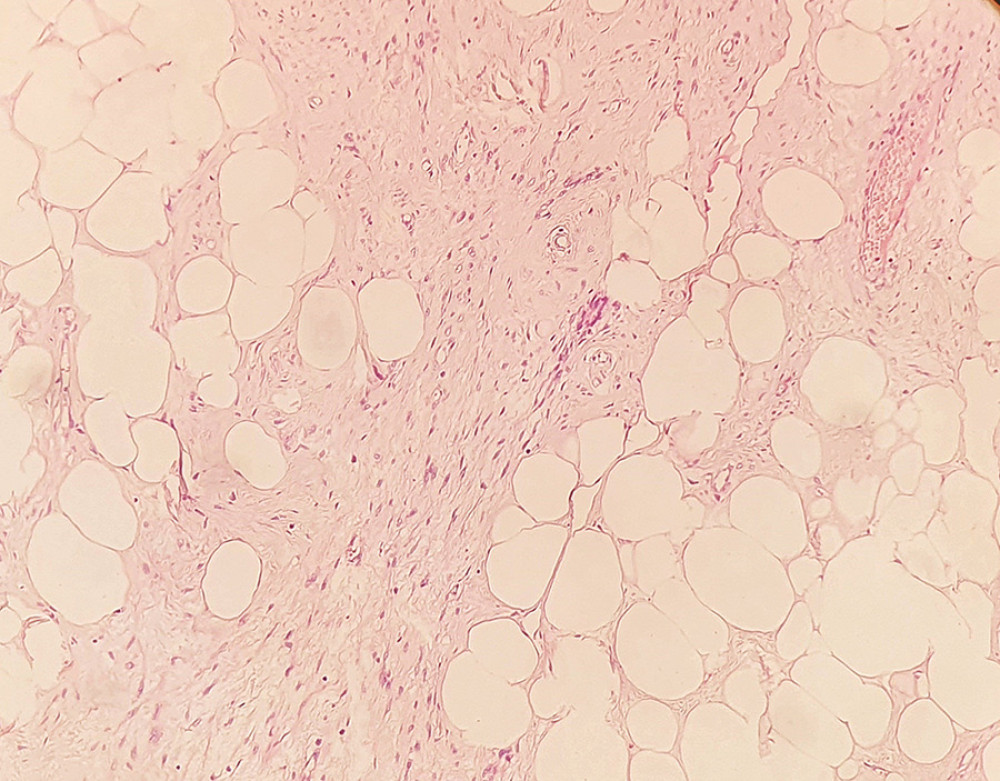 Microscopic features of lipoleiomyoma: proliferation of mature fat cells with lobular disposition, separated by thin bands of connective tissue and focally interspersed with smooth muscle fibers (HE stain, Ob ×200).