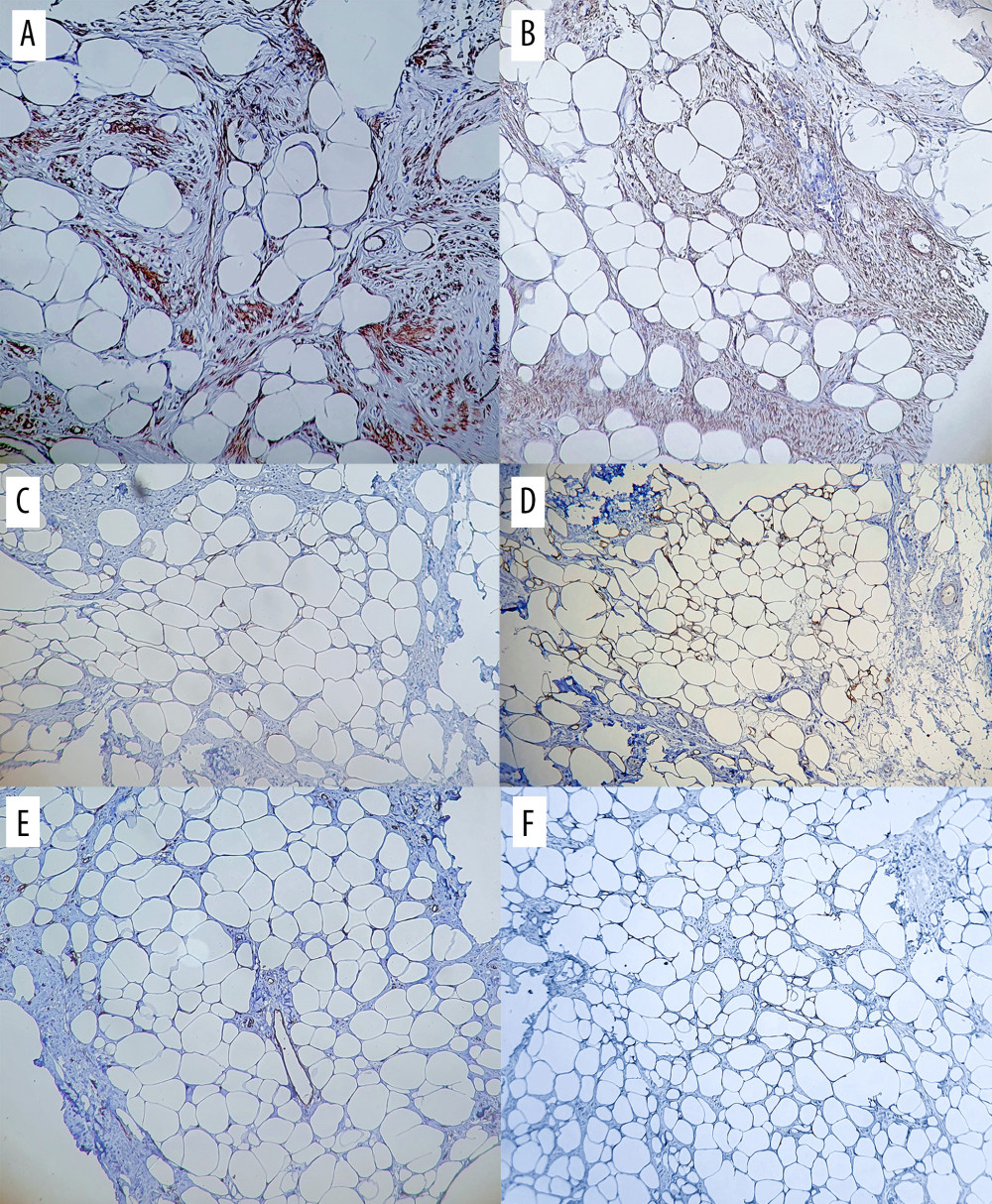 Immunohistochemical features of lipoleiomyoma. (A) Diffuse, moderately positive, cytoplasmic reaction of h-caldesmon in smooth muscle fibers (IHC stain, Ob ×200). (B) Diffuse, moderately positive, cytoplasmic reaction of desmin in smooth muscle fibers (IHC stain, Ob ×200). (C) Diffuse, moderately positive reaction for S100 in the membrane of fat cells (IHC stain, Ob ×200). (D) Diffuse, moderately positive reaction for calretinin in the nuclei of fat cells (IHC stain, Ob ×200). (E) Negative reaction for CD34 in the tumor (IHC stain, Ob ×200). (F) Negative reaction for MDM2 in the lipoleiomyoma (IHC stain, Ob ×200).