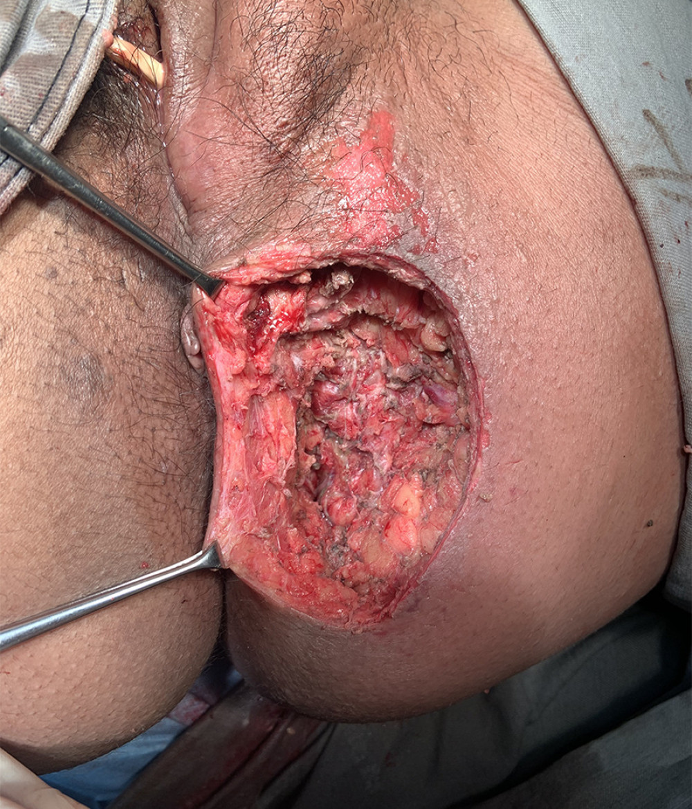 Final aspect following first drainage and debridement of necrotic tissue.