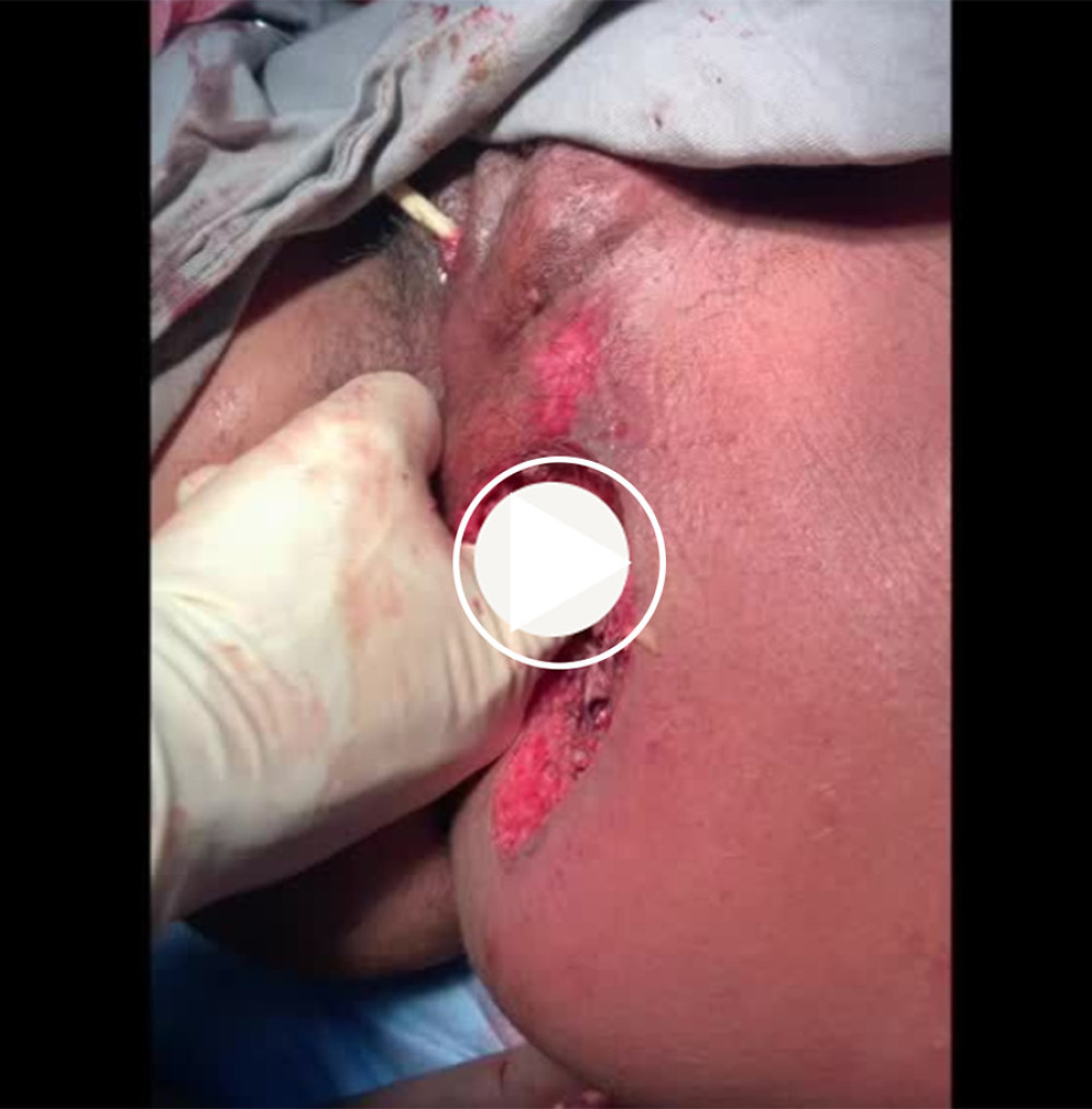 Incision and drainage of Fournier’s gangrene. Laparoscopic loop ileostomy showing enlarged uterus in the first postoperative day of cesarean section and intraoperative colonic lavage and final aspect following debridement and regional flap.