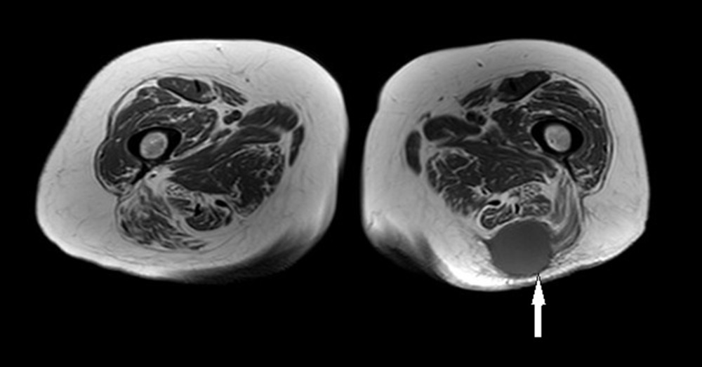 Axial T1-weighted MRI sequence depicting a homogenous low signal intensity tumor (white arrow).