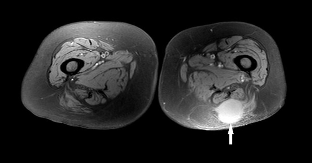 Axial T2-weighted MRI sequence depicting a homogenous high signal intensity tumor (white arrow).