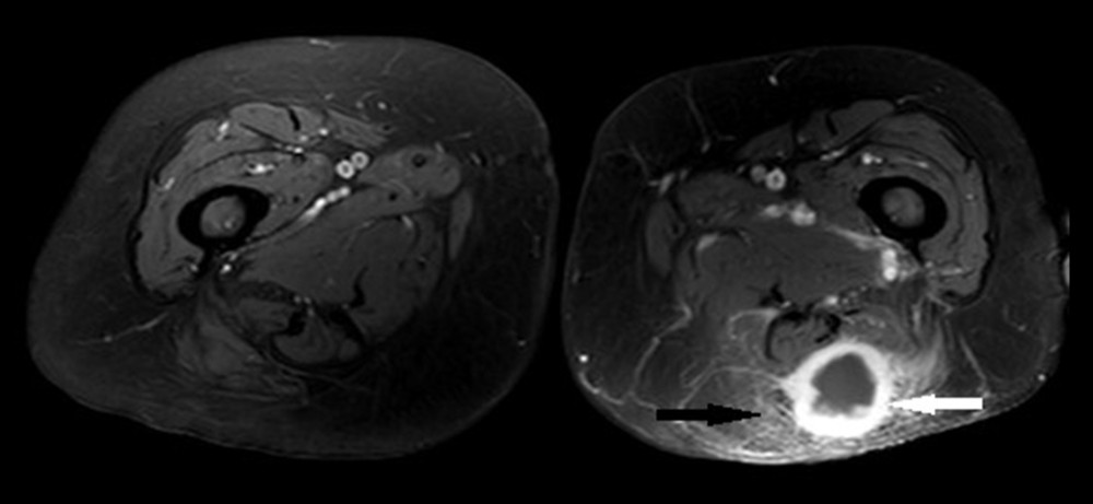 After injection of Gd-DTPA, the tumor shows strong peripheral enhancement (white arrow) with central hypoattenuation and peritumoral edema (black arrow).