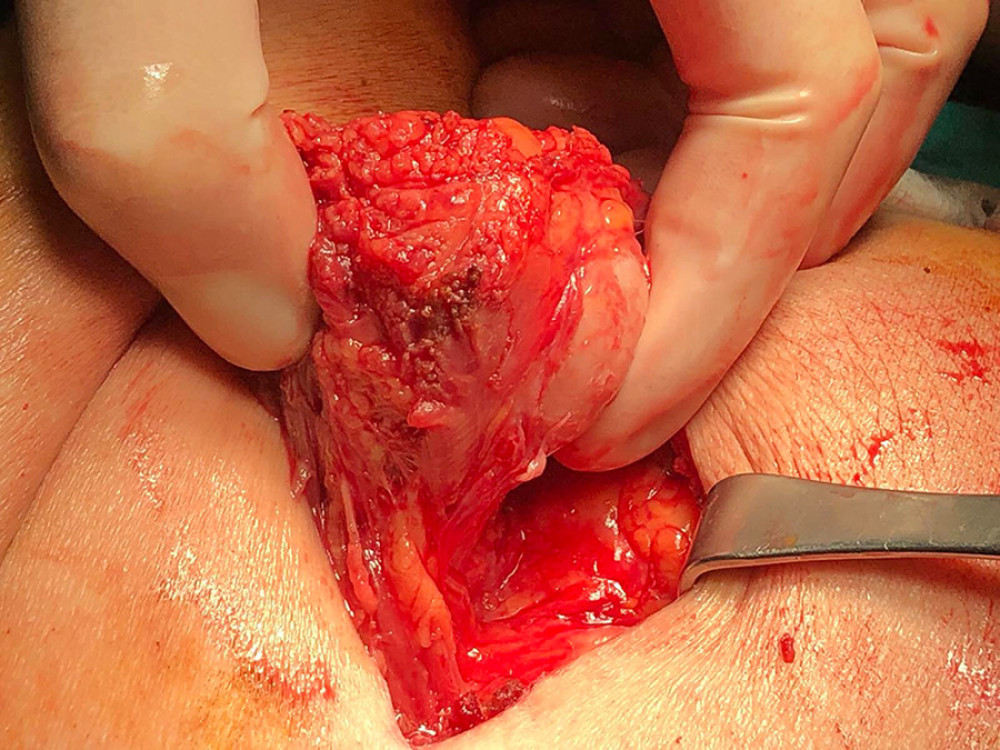 Intraoperative photo of the tumor located subcutaneously, after mobilization from the surrounding tissue.