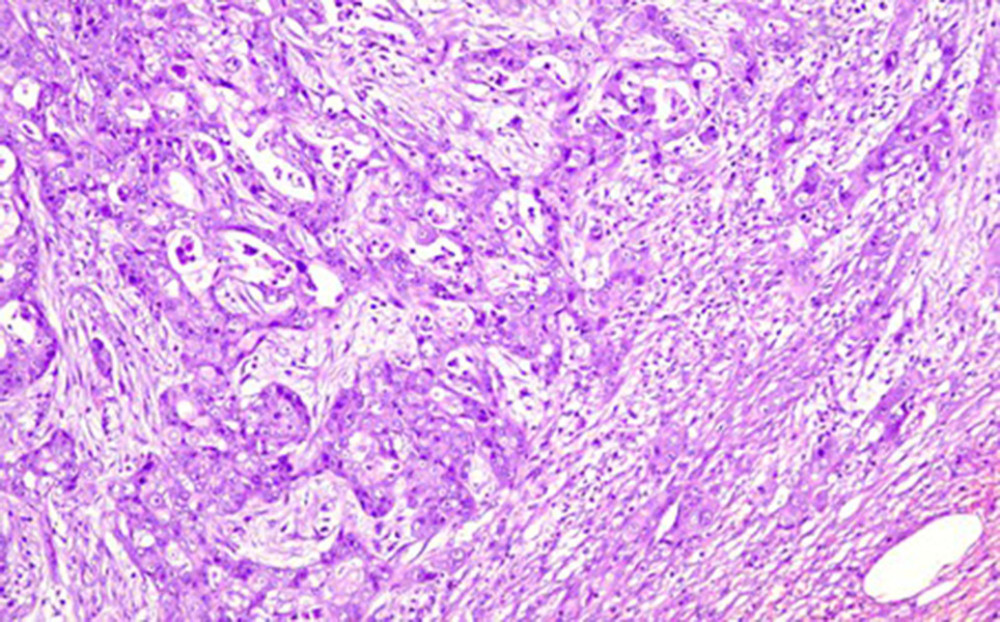 H&E, magnification scale ×100: Neoplastic cells forming adenoid and cribriform tumor clusters, invading surrounding connective tissue with desmoplastic reaction.