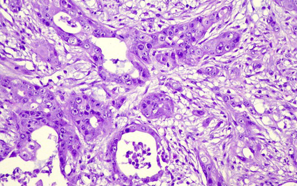 H&E, magnification scale ×200: At higher magnification, the carcinomatous cells consist of eosinophilic cytoplasm, with a high nuclear/ cytoplasmic ratio, and atypical nuclei, in various sizes, with prominent nucleoli.