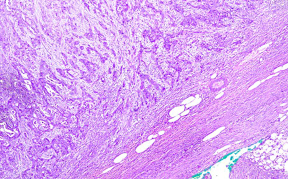 H&E, magnification scale ×40: High-grade adenocarcinoma infiltrating fibrous connective and fatty tissue. Green stain indicates the peripheral surgical margin.