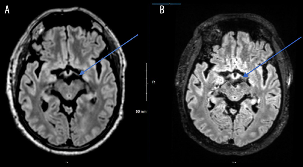 Magnetic resonance imaging (MRI) axial 3D T2 fluid-attenuated inversion recovery images of MRI brain without contrast at the level of the midbrain (A) compared with an MRI brain done 2 months prior (B) demonstrates increased cerebral spinal fluid spaces in the interpeduncular, suprasellar, ambient, quadrigeminal cisterns, and Sylvian fissures.