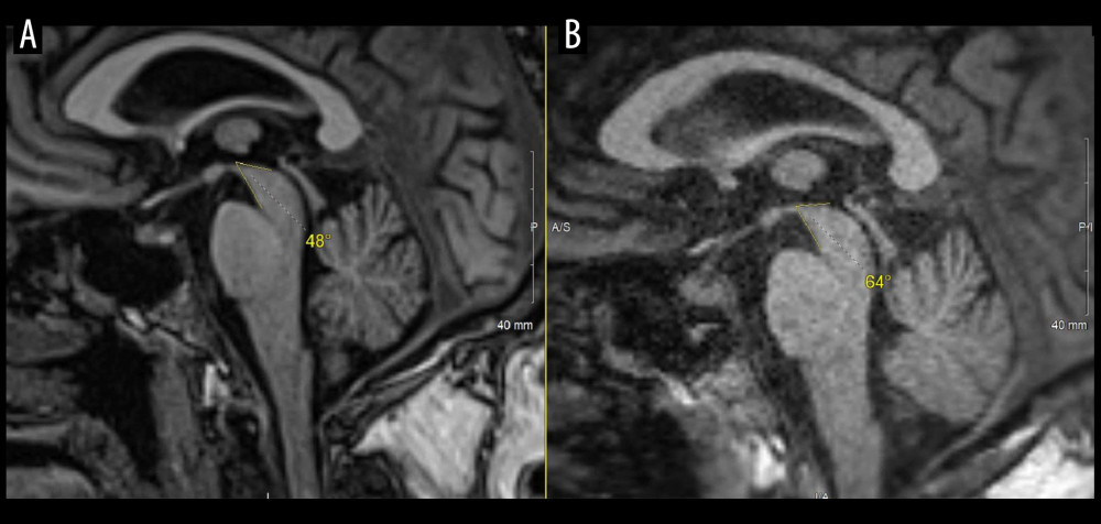 Sagittal isotropic 3D T1 magnetization prepared rapid gradient echo section of brain magnetic resonance imaging (MRI) after onset of tremors (A) compared with the MRI obtained 2 months prior (B). Measuring the angle between the ventral midbrain along interpeduncular cistern and the floor of the third ventricle demonstrates a more acute morphology in Figure A compared with Figure B, consistent with radiographically observed thinning of the midbrain.