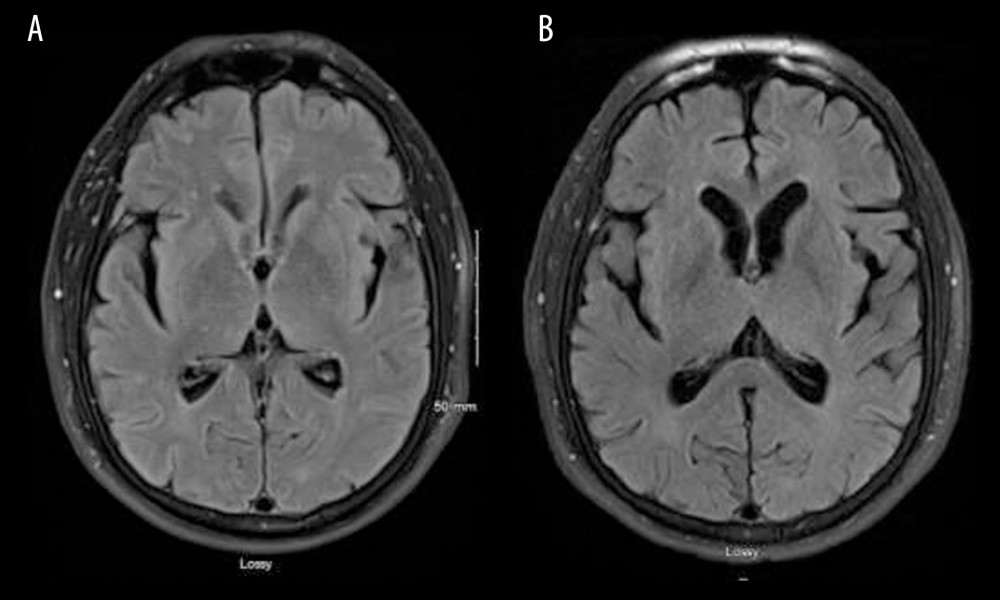 Magnetic resonance imaging (MRI) axial 3D T2 fluid-attenuated inversion recovery images of brain MRI without contrast at the level of the basal ganglia (A) compared with the brain MRI done 2 months prior (B), demonstrating no major changes in between the 2 images.