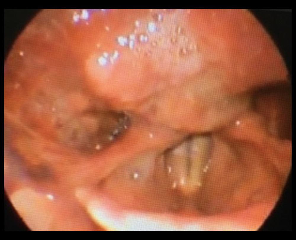 Endoscopic image: posterior hypopharynx wall tumor.