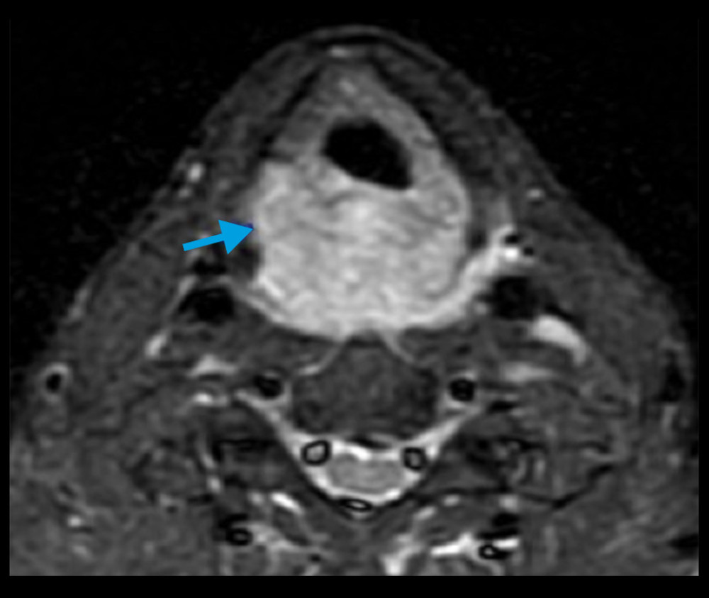 MRI image: tumor’s invasion into the right pyriform sinus (blue arrow) and the cervical esophagus.