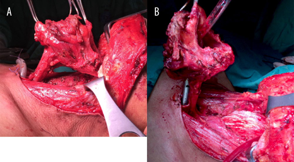 (A, B) Total pharyngo-laryngo-cervico-esophagectomy: from the oropharynx to upper border of the thoracic esophagus, anteriorly passing the root of the tongue.