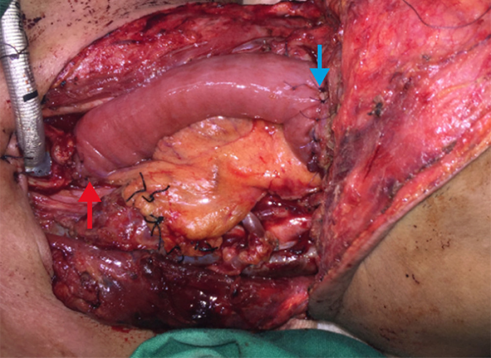 The flap is sutured end-to-end: the upper end to the pharynx after free longitudinal incision (blue arrow) and the lower end to the thoracic esophagus (red arrow).