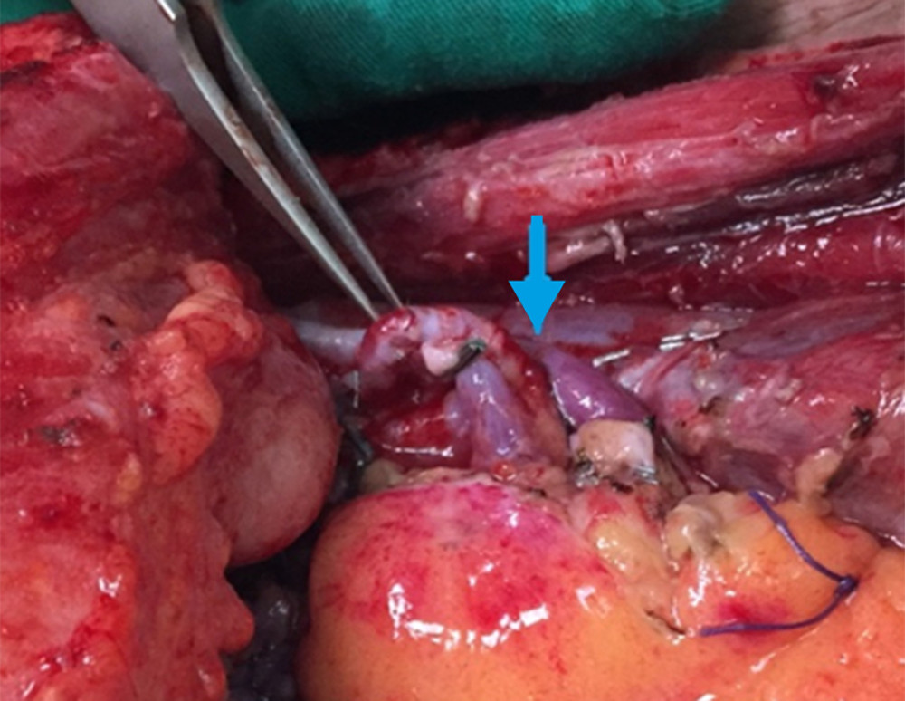 Vascular anastomosis with the superior thyroid artery (forceps tip) and the left facial vein (blue arrow) using end-to-end anastomosis.
